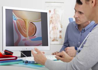 2 de cada 10 hombres se harán cirugía de próstata