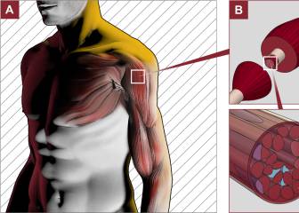 Qué es la Enfermedad de Pompe, y por qué necesita investigación