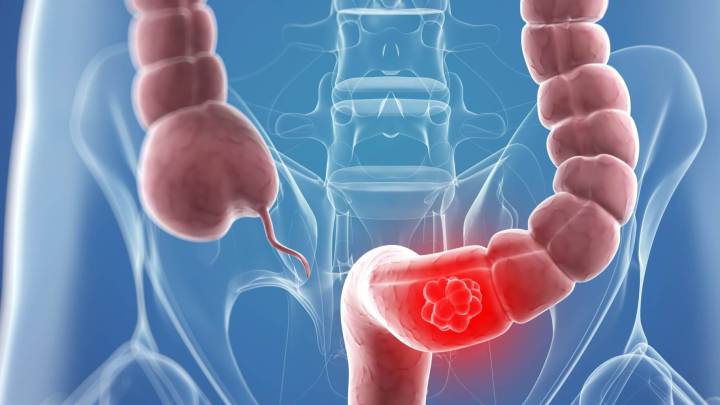 España: se detectan más de 62.000 tumores digestivos al año