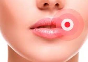 Por qué utilizar el ajo para curar el herpes labial