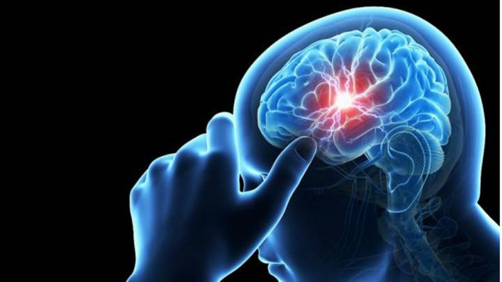 Cómo afecta al cuerpo un aneurisma cerebral - AS.com