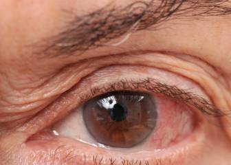 25.000 españoles podrían sufrir ceguera total por el glaucoma
