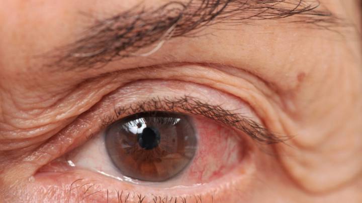 25.000 españoles podrían sufrir ceguera total por el glaucoma