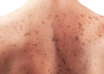 Ya puedes calcular tu riesgo de padecer melanoma