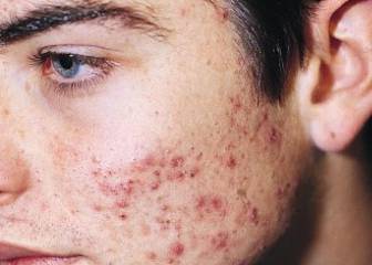 Las posibles maneras de controlar el acné para todos