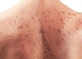 Ya puedes calcular tu riesgo de padecer melanoma