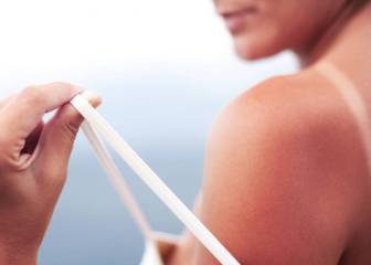 Así hay que actuar ante una quemadura solar