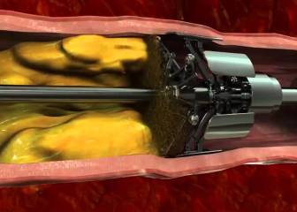 Un gadget para limpiar el colesterol de la sangre