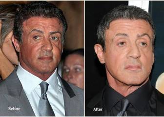 Las operaciones de estética más demandadas por los hombres