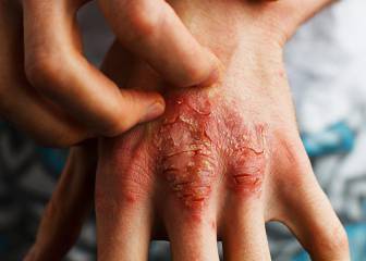 Vivir con dermatitis atópica: mucho más allá del picor