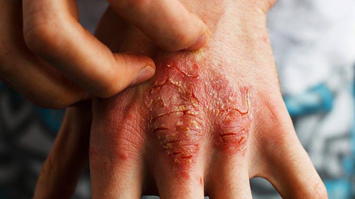 con dermatitis atópica: más allá del picor AS.com
