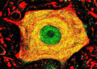 Un hallazgo esperanzador sobre la ELA abre la vía de nuevos enfoques terapéuticos