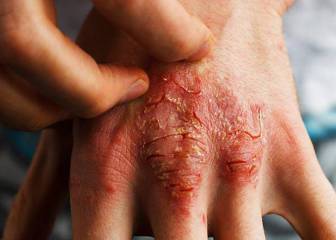 dermatitis atopica