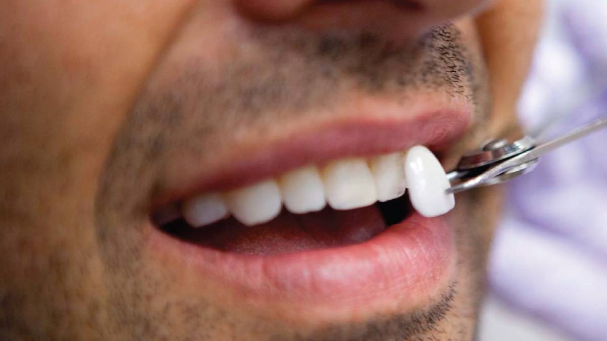 Cuándo son útiles las carillas dentales?