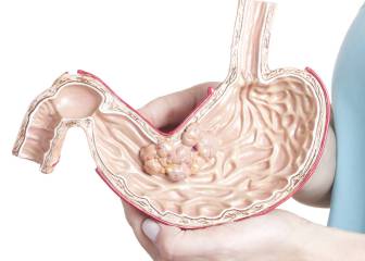 Estrés, drogas y una mala alimentación provocan reflujo gástrico