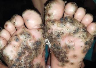 Tungiasis: la infección que ha poblado de pulgas los pies de una niña de 10 años