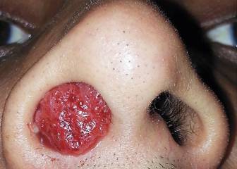 Rinosporidiosis: mucho cuidado al escoger zona de baño porque estas cosas pasan