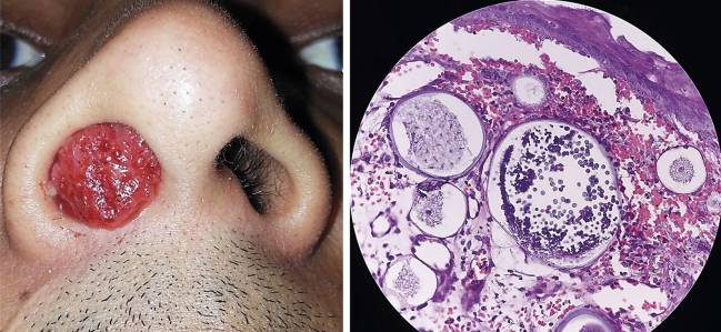 rinosporidiosis, enfermedad rara, salud