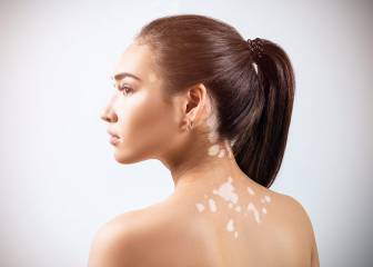 4 enfermedades de la piel que mejoran cuando estás en la playa