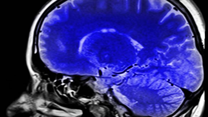 Vista de una resonancia magnética con el cerebro coloreado de azul.