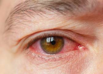 El 20 % de los afectados por COVID-19 tuvo conjuntivitis