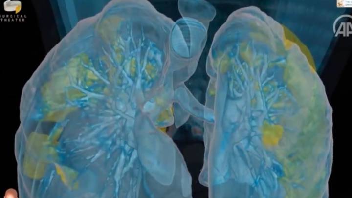 La recreacin en realidad virtual que muestra los estragos del Covid-19 en los pulmones