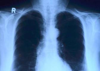 Un proyecto español con IA detecta el coronavirus con una radiografía de torax