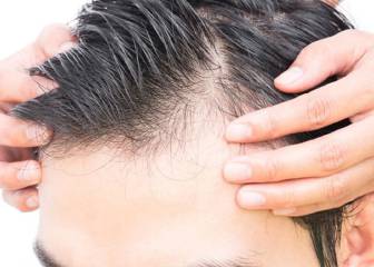 La pandemia puede contribuir a aumentar la caída del pelo