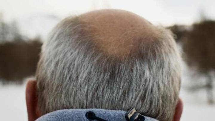 Bald men may be at higher risk of hospitalisation from coronavirus