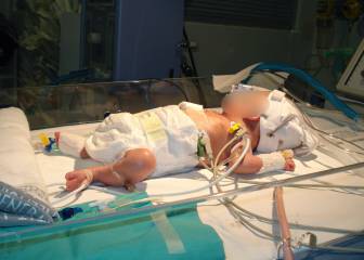 Un bebé prematuro de 580 gramos nacido en Perú consigue vencer al coronavirus