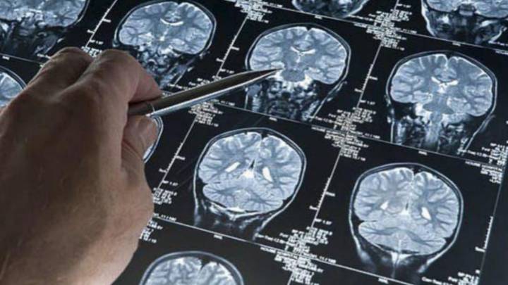 Científicos de USA encuentran una forma de detección temprana del Alzheimer