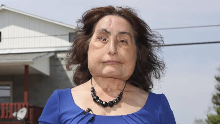 Muere Connie Culp, la mujer que recibió el primer trasplante de cara en Estados Unidos