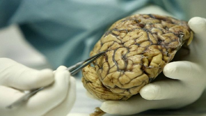 Detectan 'células zombies' en el cerebro humano tras la muerte