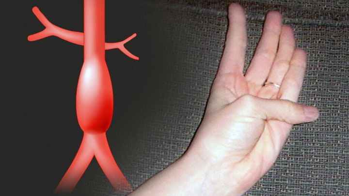 Cómo saber si tenemos una condición cardiovascular grave con un movimiento de dedo