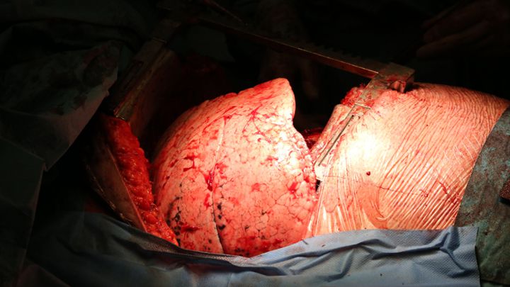 pulmones doble trasplante covid-19