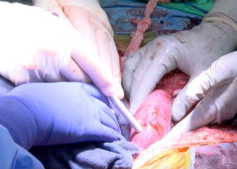 Primer trasplante de dos riñones de un cerdo a un humano