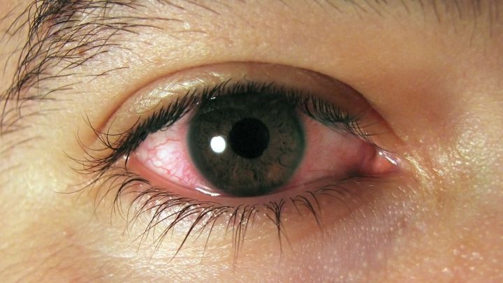 ¿Por qué pican los ojos con la alergia y cuáles son los síntomas de la conjuntivitis alérgica?