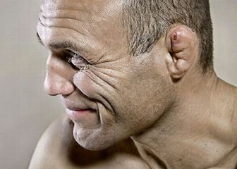 Boxer's ear: A fighter's badge