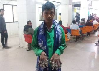 La complicada vida del 'hombre-árbol' de Bangladesh