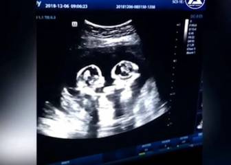 Una ecografía capta la ‘pelea’ entre dos gemelas en el vientre de su madre