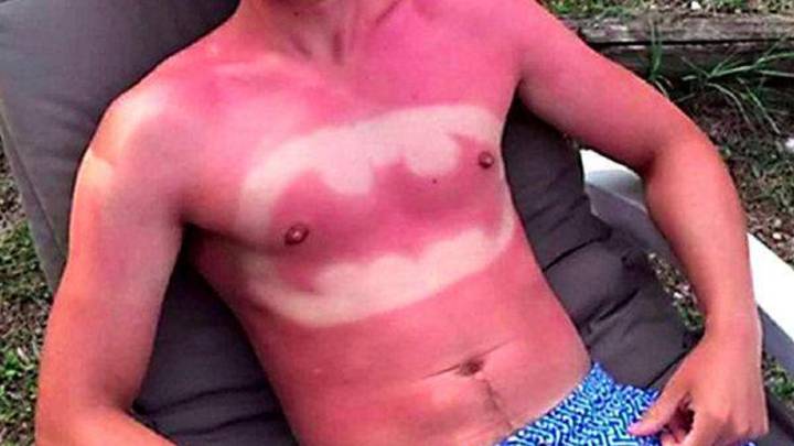 'SunburnArt': la moda de 'tatuarse' la piel quemándose al sol de la que advierte la Guardia Civil
