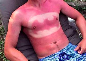 La moda de 'tatuarse' la piel quemándose al sol de la que advierte la Guardia Civil