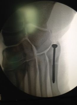 Xabi Alonso lleva un clavo de titanio en su pie derecho