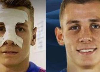 ¿Se ha operado Lucas Digne las orejas al fichar por el Barça?