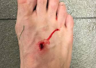 Luis Suarez’s studs leave their mark on Filipe Luis