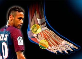 El gráfico que explica cómo es la lesión de Neymar