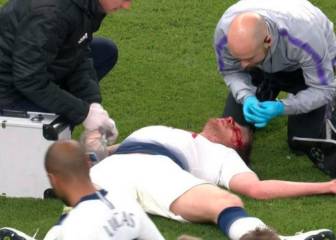 Vertonghen carried off field after suffering blow to the head