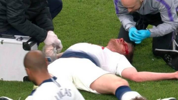 Vertonghen carried off field after suffering blow to the head