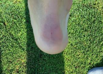 Morata's damaged heel somewhat explains furious red-card reaction