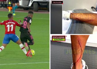 Así quedó la pierna de Marvin tras el entradón de Machís que no fue ni amarilla